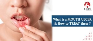 What is a Mouth Ulcer & How to Treat Them? - BJain Pharma