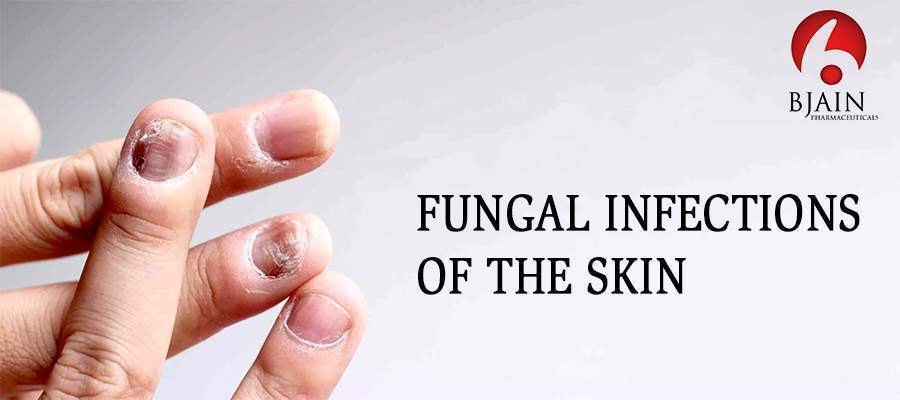 Fungal Skin Infections: Types, Symptoms and Treatments