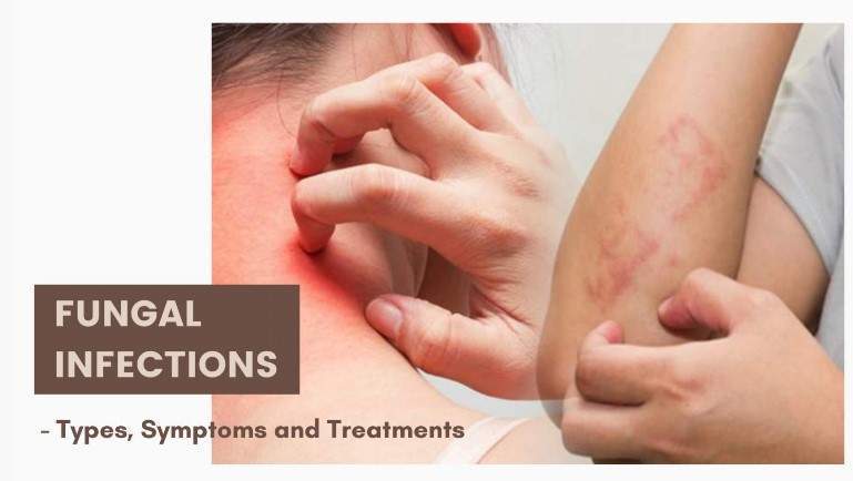 Fungal Skin Infections: Types, Symptoms and Treatments