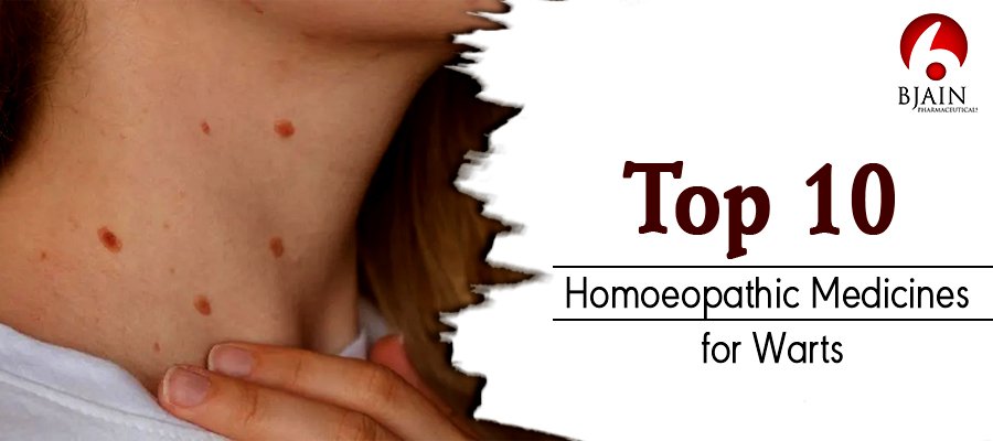 Top 10 Homeopathic Medicines for Warts