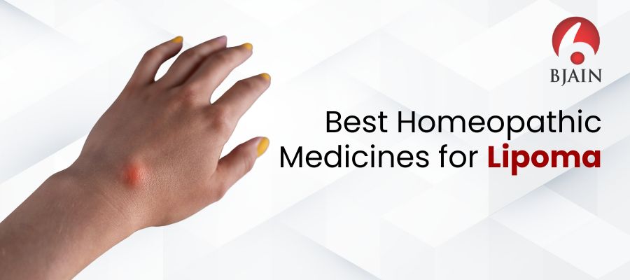 Best Homeopathic Medicines for Lipoma