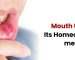 Mouth Ulcer & its Homeopathic Medicines